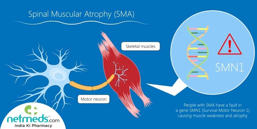 Spinal Muscular Atrophy