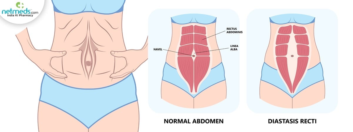 how to reduce mommy pouch
