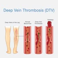 Deep Vein Thrombosis: Causes, Symptoms And Treatment