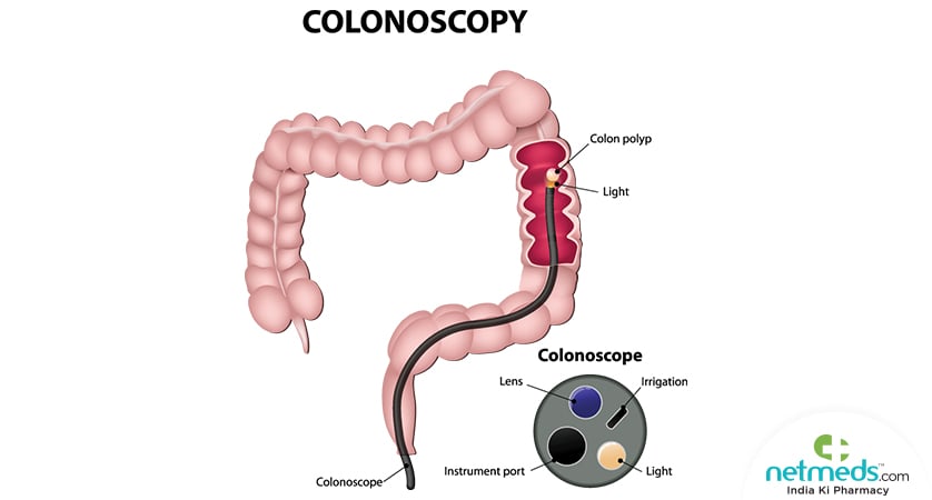 Colonoscopy