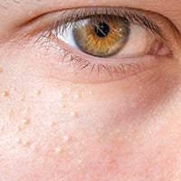 Milia: Try These Proven Ways To Get Rid Of These Milk Spots On Skin