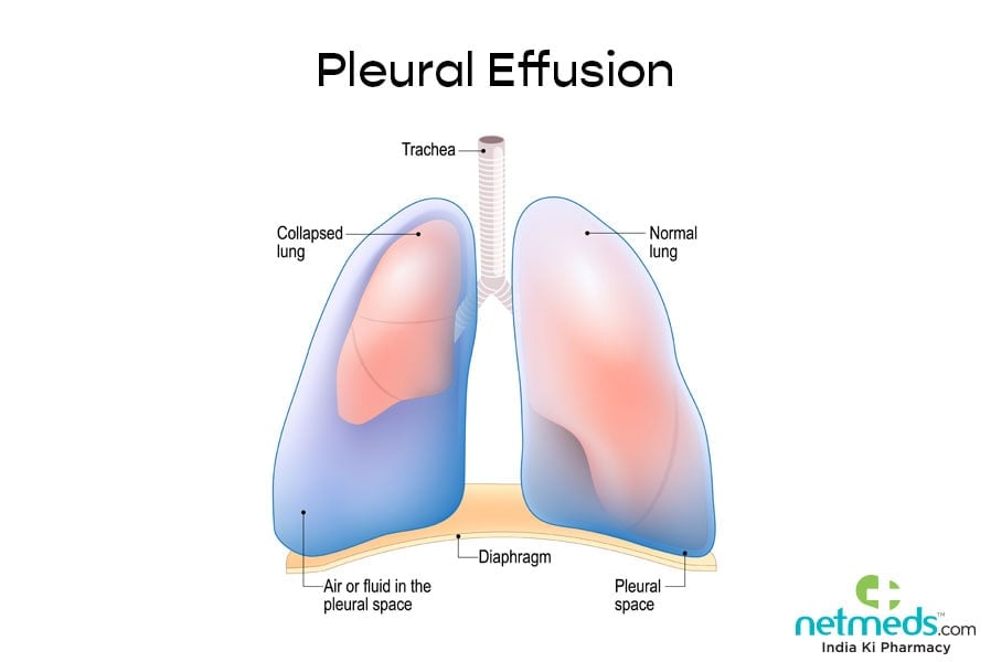 Pleural effusion