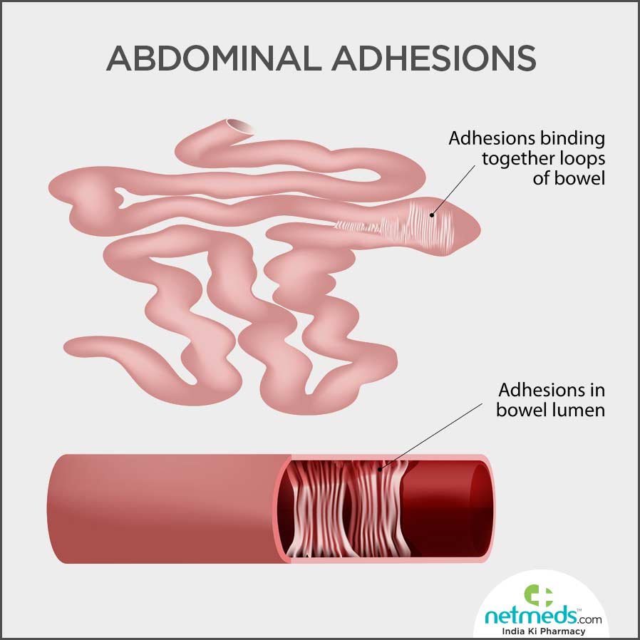 Abdominal adhesions causes