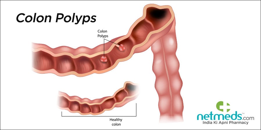 Colon Polyps