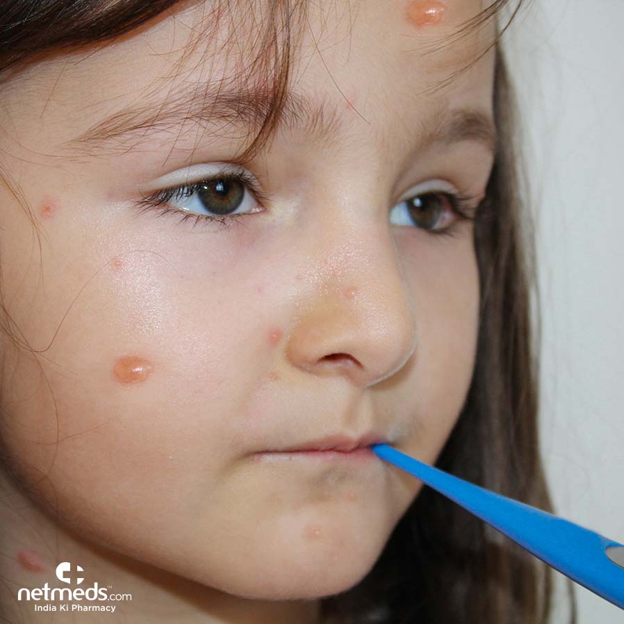 A girl with chickenpox