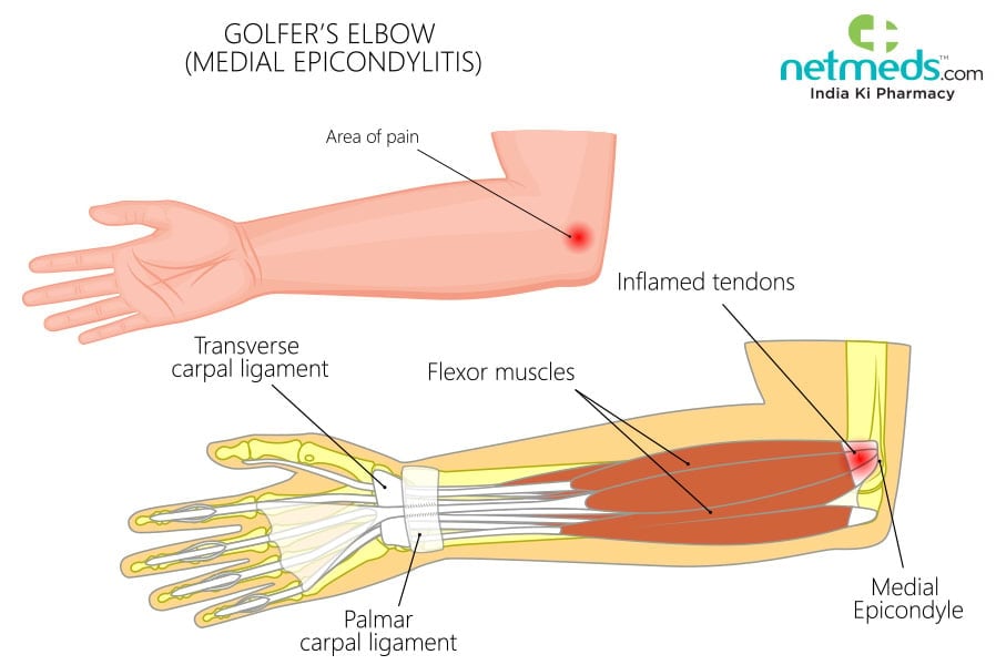 golfer's elbow