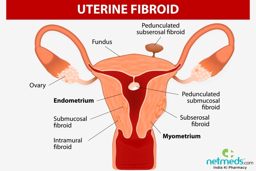 Uterine Fibroids