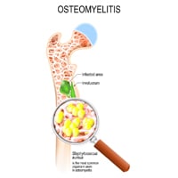 Osteomyelitis: Symptoms, Causes, Diagnosis And Treatment