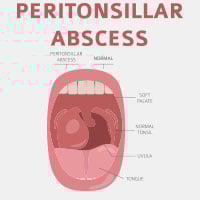 Peritonsillar Abscess: Causes, Symptoms And Treatment