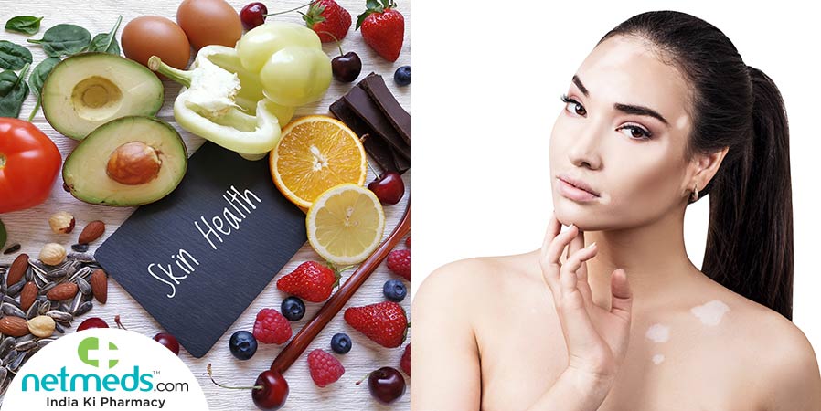 Skin Health food and woman with vitiligo