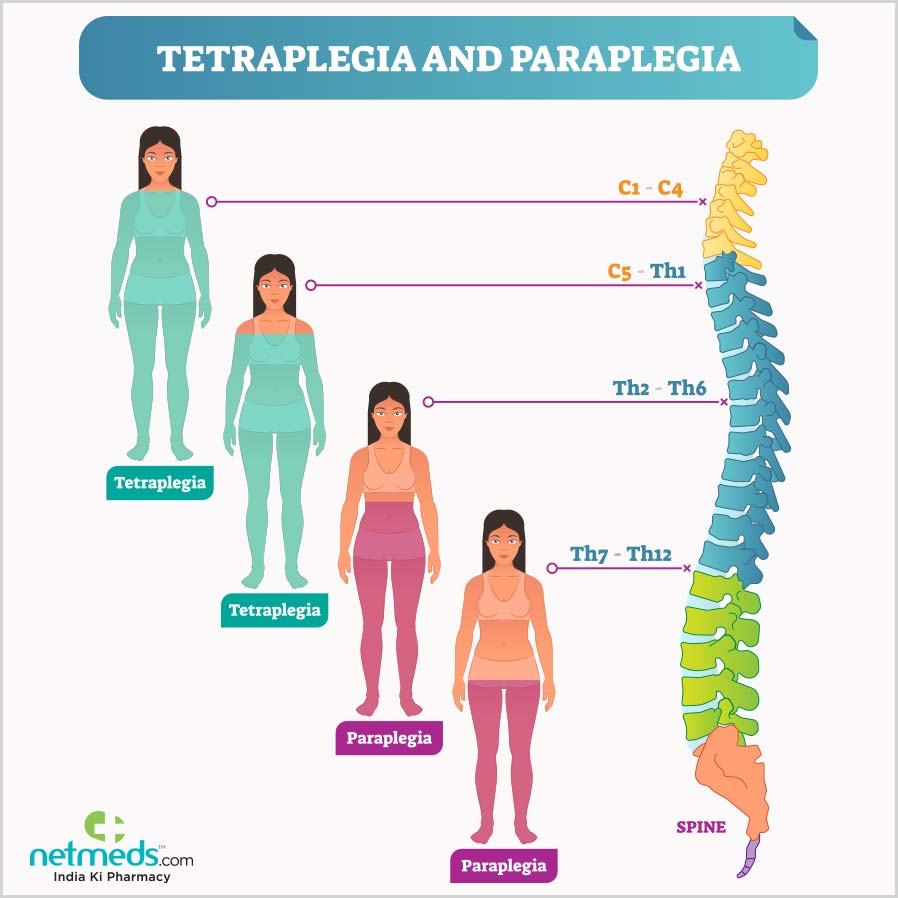 paraplegia