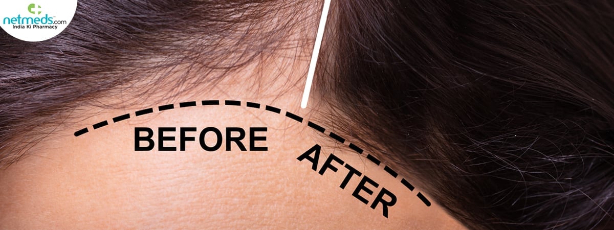 hair loss