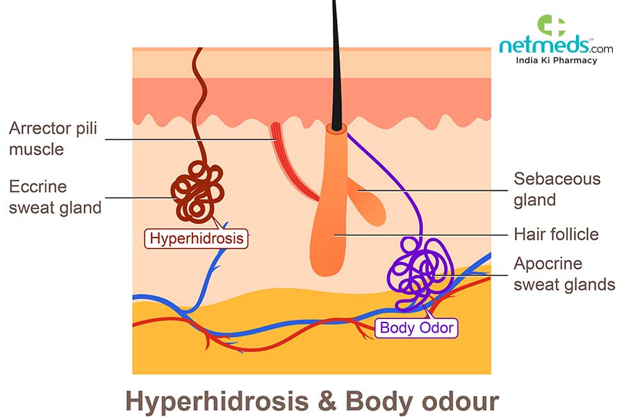 Hyperhidrosis