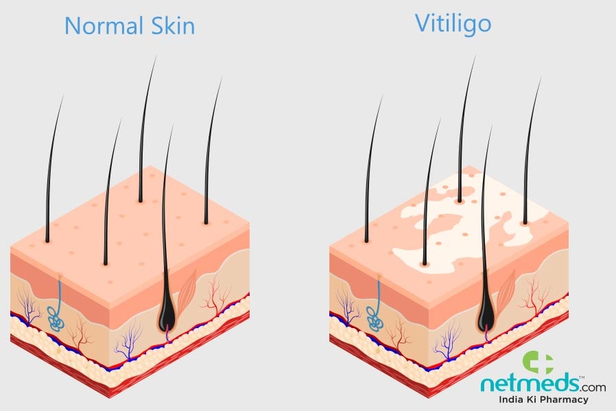 vitiligo
