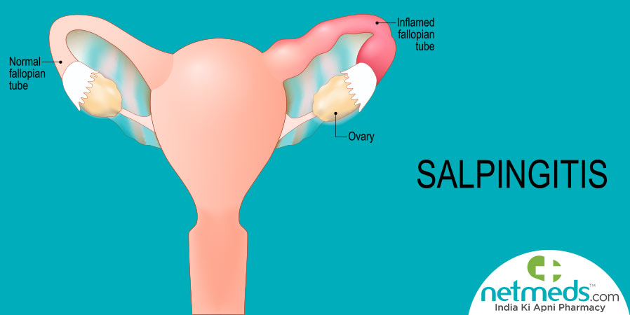 Salpingitis