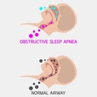 Obstructive Sleep Apnea: Causes, Symptoms And Treatment