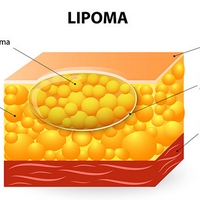 Lump under your skin? It could be a lipoma