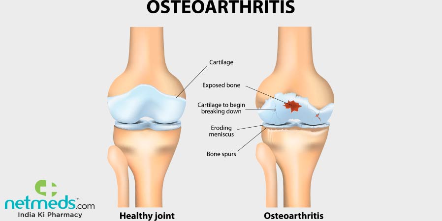Osteoarthritis