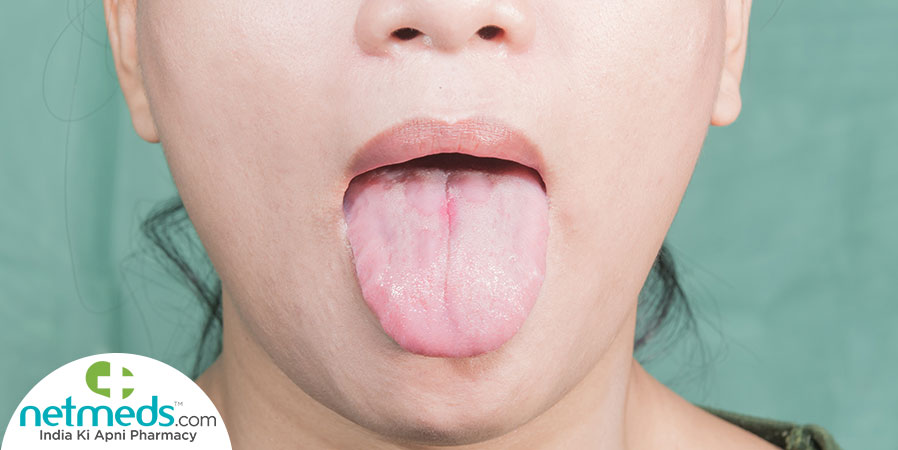 Woman showing glossitis