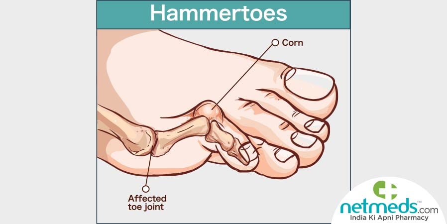 Hammertoes