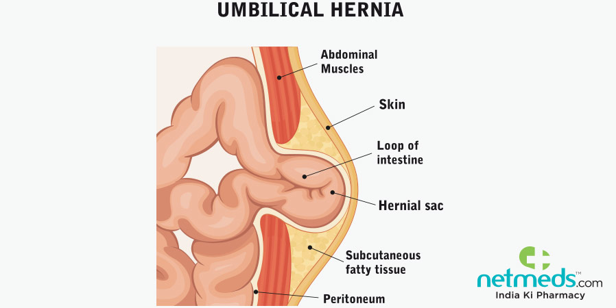 Causes, Symptoms And Treatment Of Umbilical Hernia