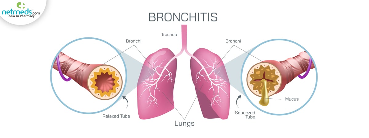 bronchitis symptoms