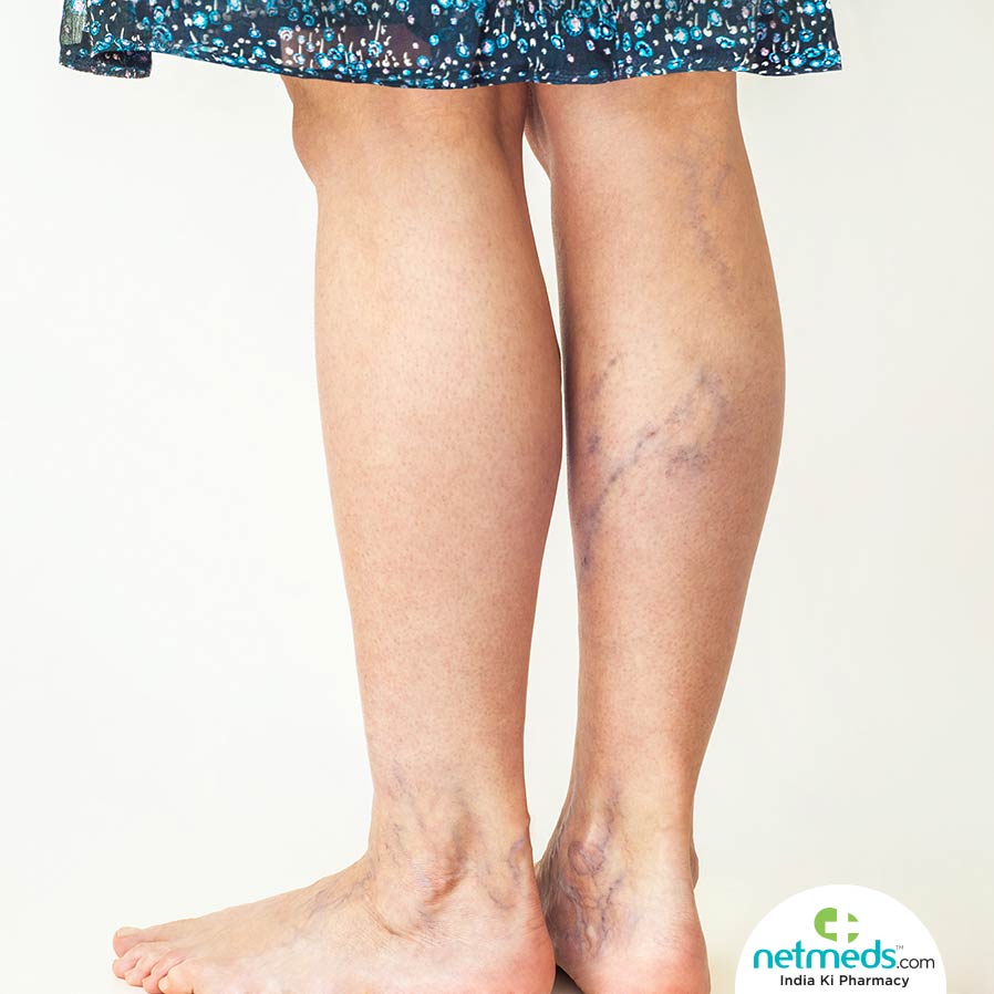 Varicose Veins