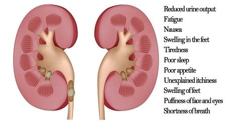 Kidney Stone