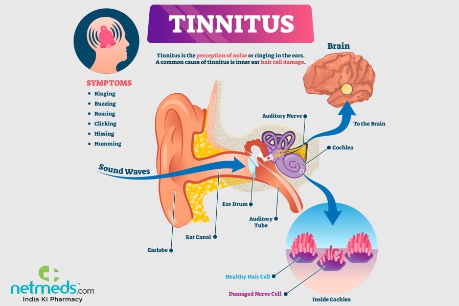tinnitus