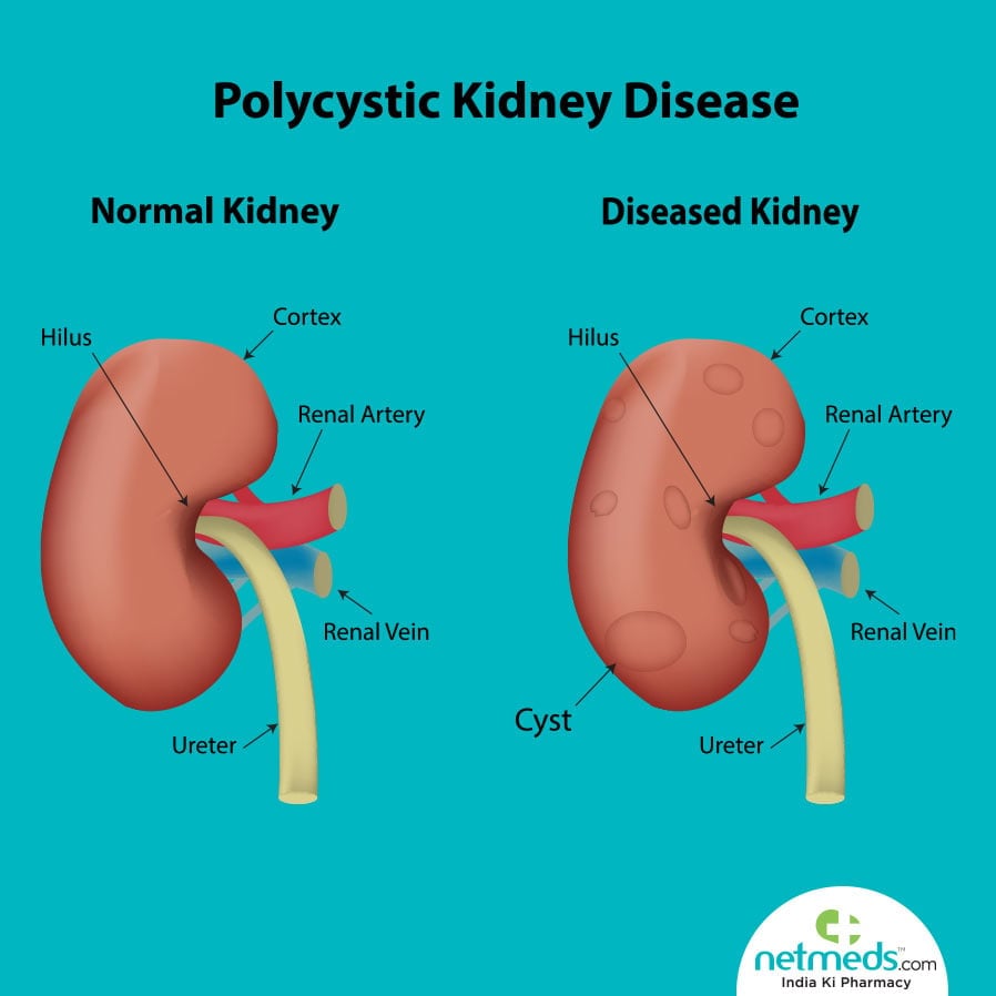 Polycystic kidney disease