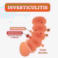 Diverticulitis : Causes, Symptoms and Treatment
