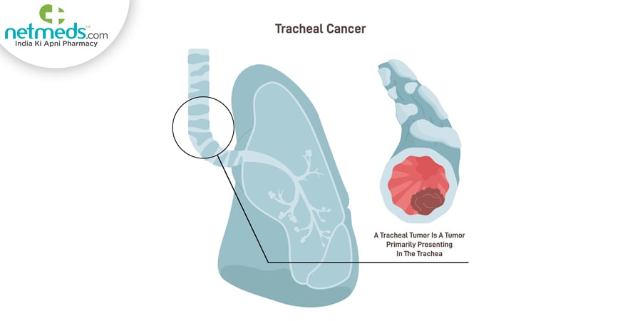 Tracheal Cancer
