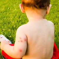 How To Treat Bug Bites Naturally In Kids? 7 Best Home Ingredients That Calm Itchy Skin Fast