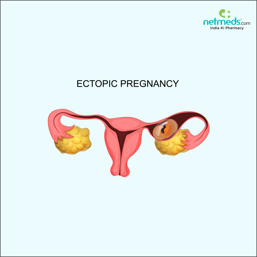 Ectopic Pregnancy