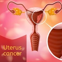 Uterine Cancer: Causes, Symptoms And Treatment