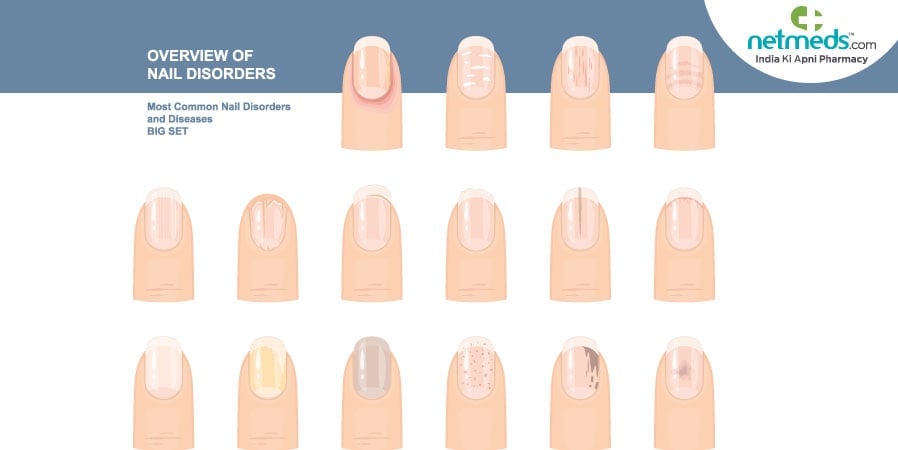 overview of nail disorders