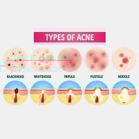 Types Of Acne: Know The Difference Between Blackheads, Whiteheads, Nodules And Cysts