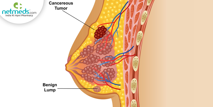Breast Conditions