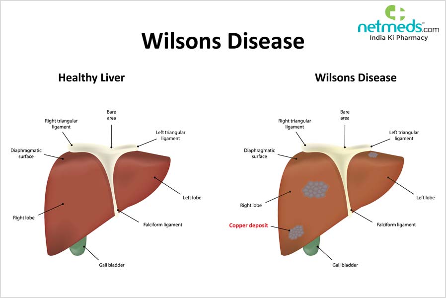 Wilson's Disease