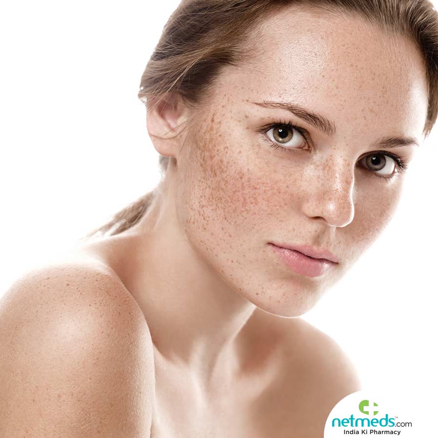 Hyperpigmentation Is Hormonal