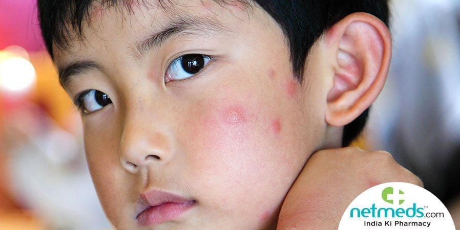 Kid with mosquito bites