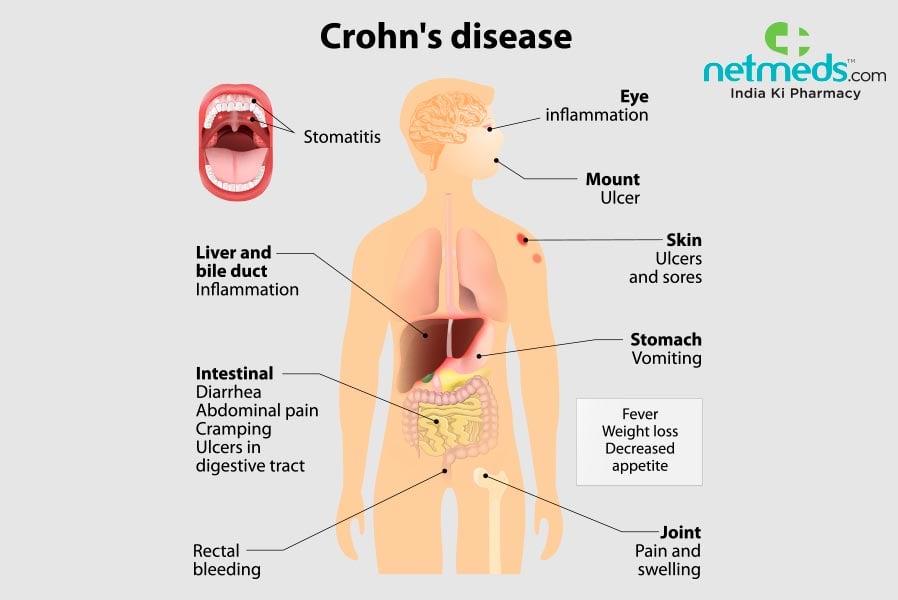 crohn's disease