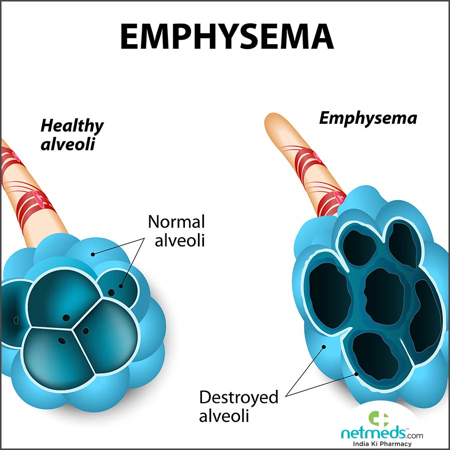 emphysema in lungs
