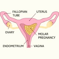 Molar Pregnancy: Causes, Symptoms And Treatment