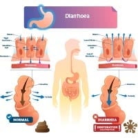 Diarrhoea: Causes, Symptoms and Treatment