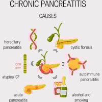 Autoimmune Pancreatitis: Causes, Symptoms And Treatment