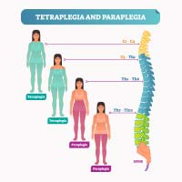 Paraplegia: Causes, Symptoms And Treatment
