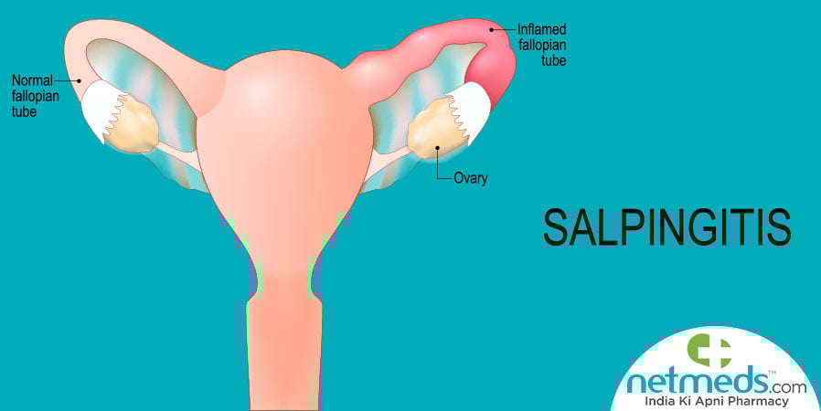 Salpingitis