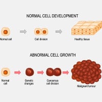 Carcinoid Tumours: Causes, Symptoms And Treatment