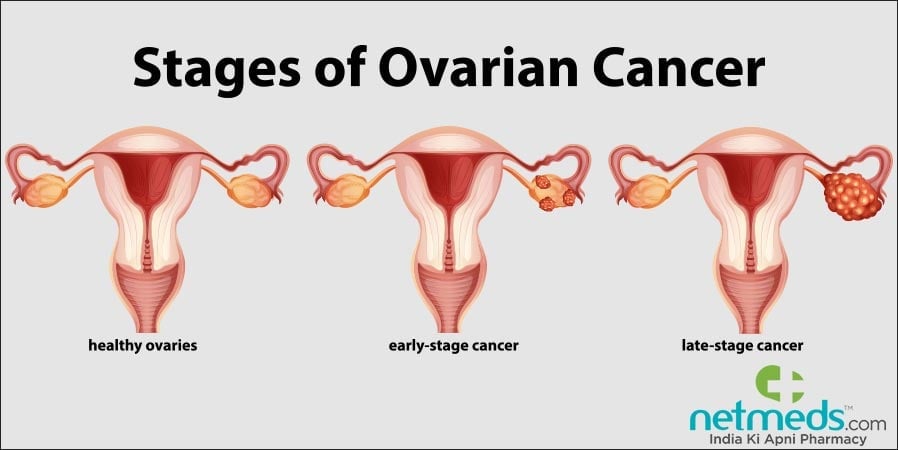 Stages of ovarian cancer